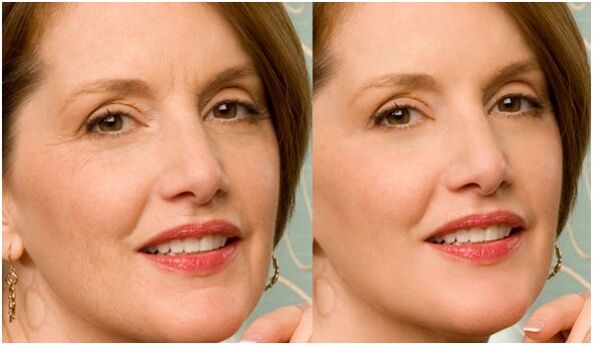 pirms un pēc sejas ādas atjaunošanas ar plazmu