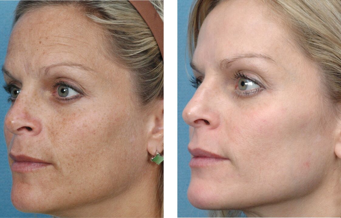 foto pirms un pēc ādas atjaunošanas 1