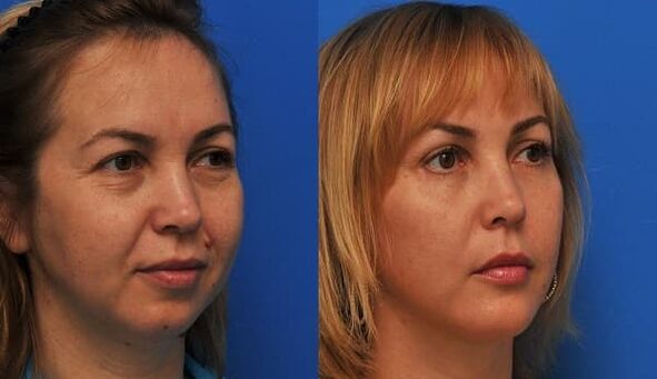 pirms un pēc ādas atjaunošanas ar savelkošu foto 1