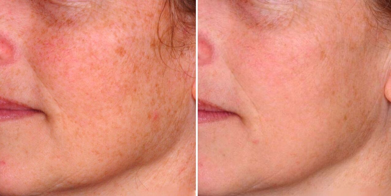 Frakcionētas fototermolīzes rezultāts ir vecuma plankumu samazināšanās uz sejas ādas. 