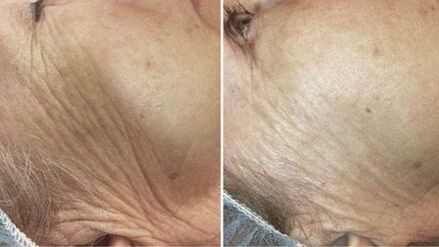 pirms un pēc lāzera ādas atjaunošanas