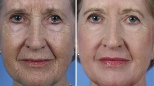 frakcionēta sejas atjaunošana pirms un pēc fotogrāfijām